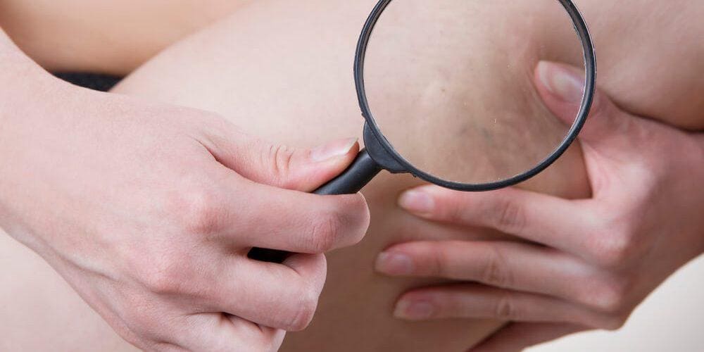 Carboxiterapia: saiba como funciona para tratar estrias e celulites