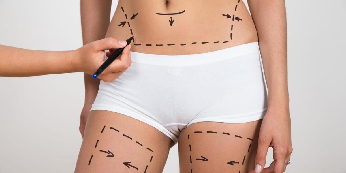 Entenda as diferenças entre lipoaspiração e lipoescultura