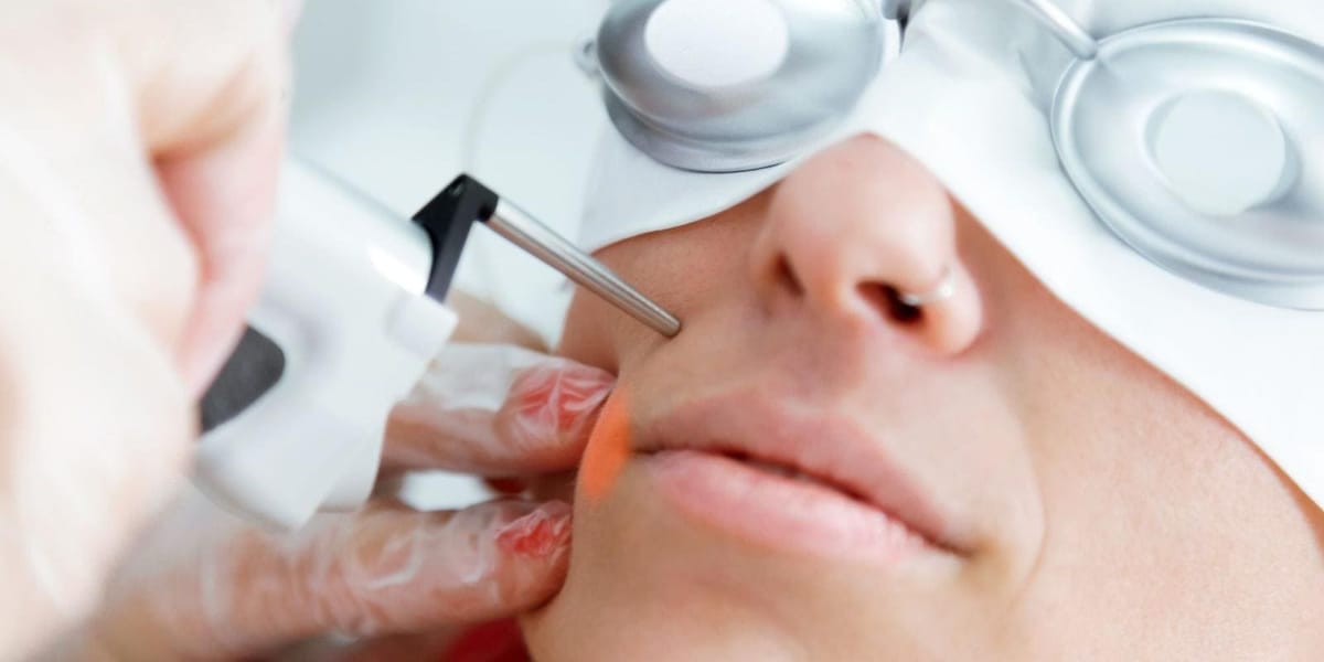 Resurfacing a laser: o que é, para quem é indicado e mais!