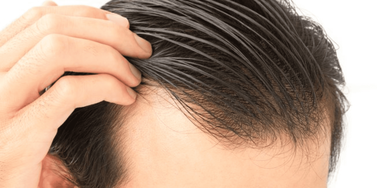 Depois do transplante capilar o cabelo pode cair?