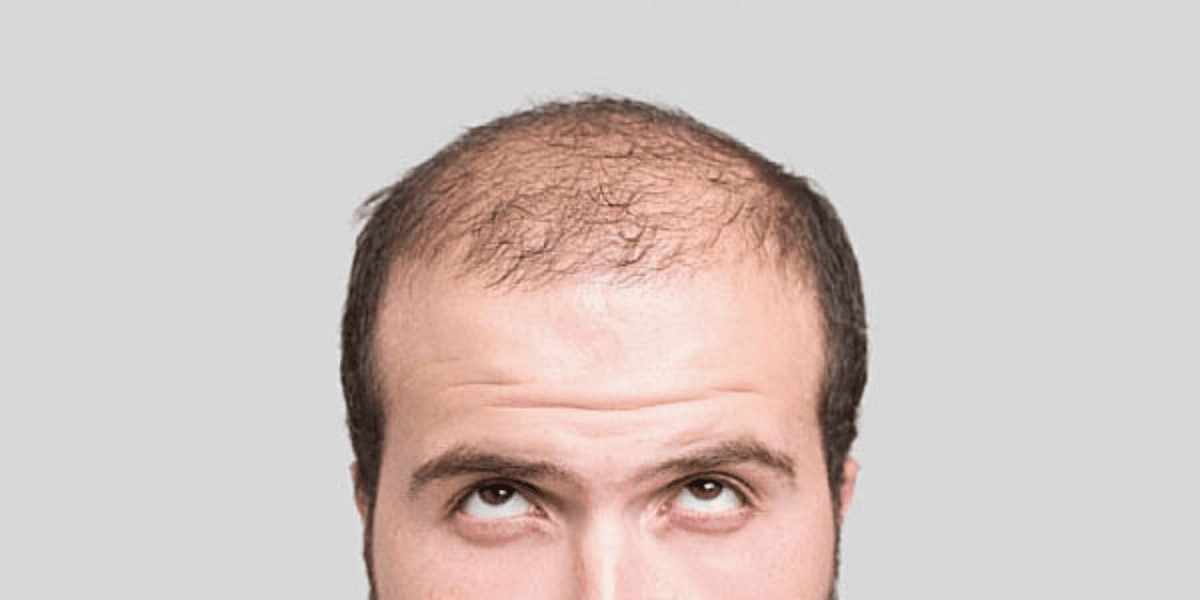 O que dói mais: perder cabelo ou o transplante capilar? 
