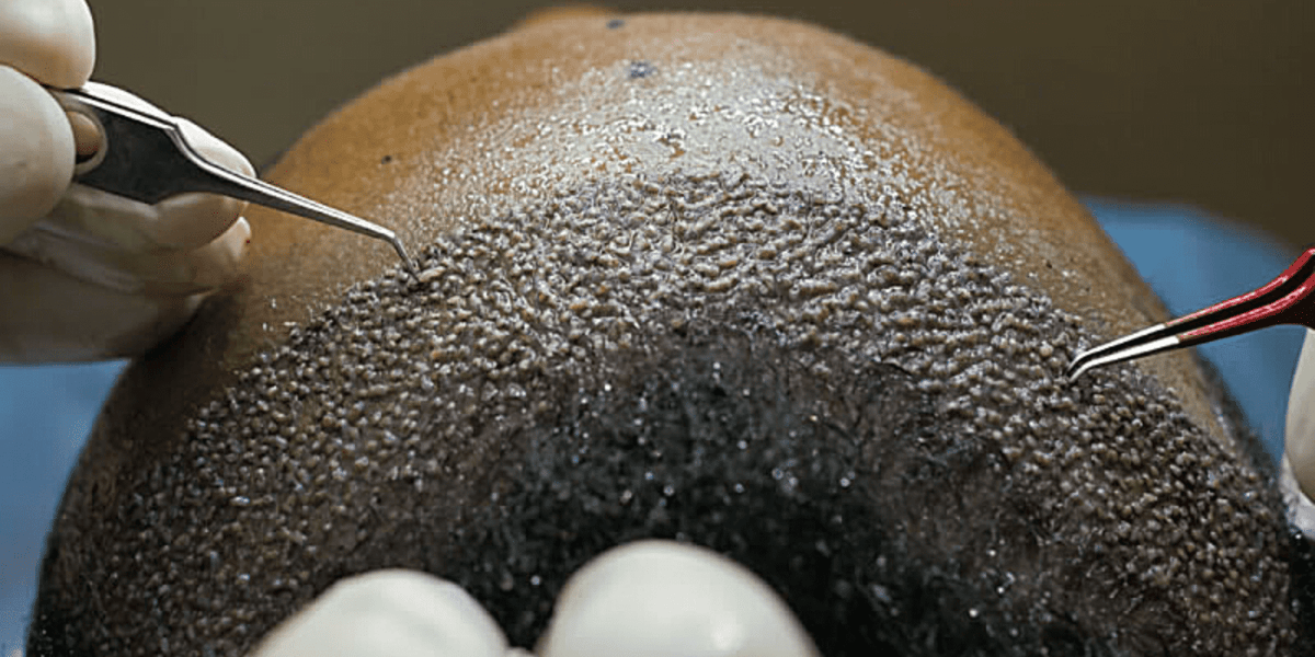 O que pode fazer depois do transplante capilar