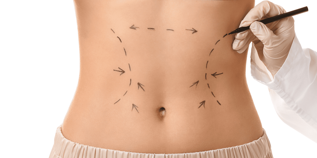 Qual o tempo de recuperação após uma Lipo HD?