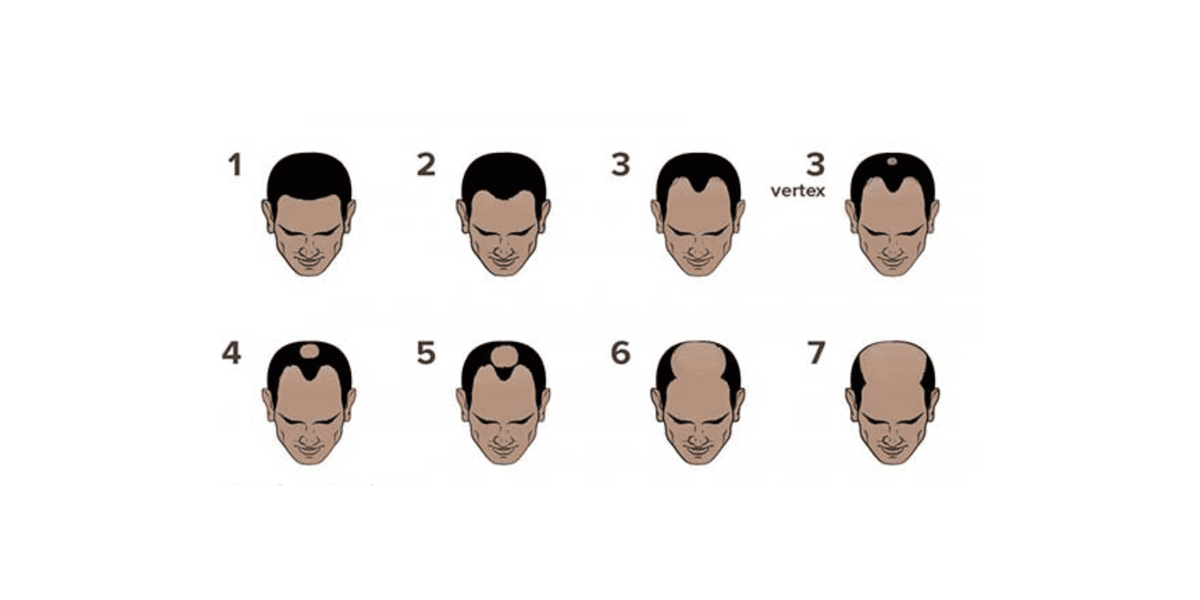 Toda pessoa com calvície precisa de transplante capilar?