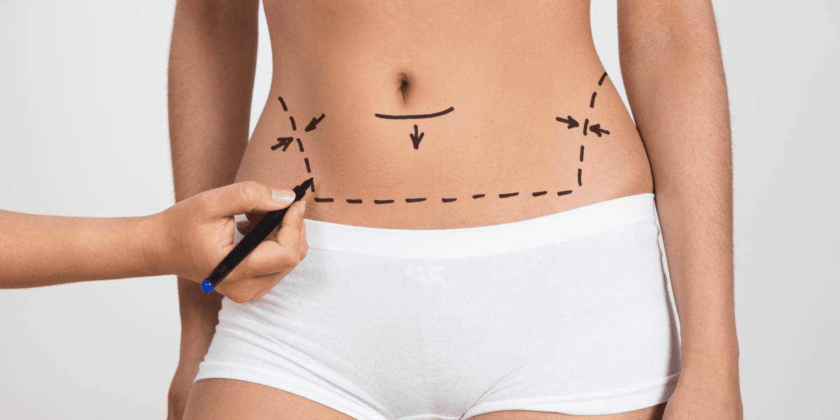 O que é possível fazer antes de optar pela lipoaspiração?