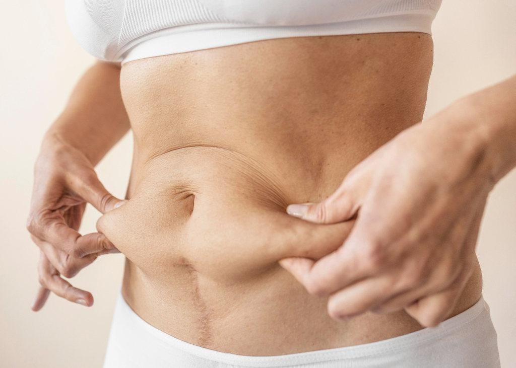 Diástase Abdominal: o que é, causas e tratamento definitivo