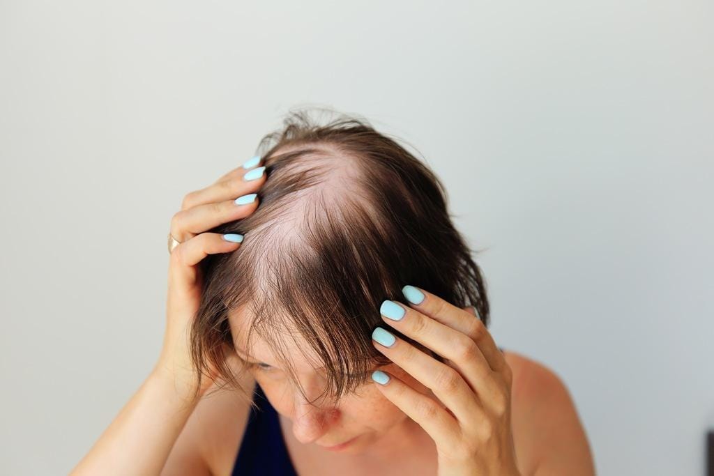 Calvície feminina: quais os sintomas? Saiba como tratar e resolver o problema