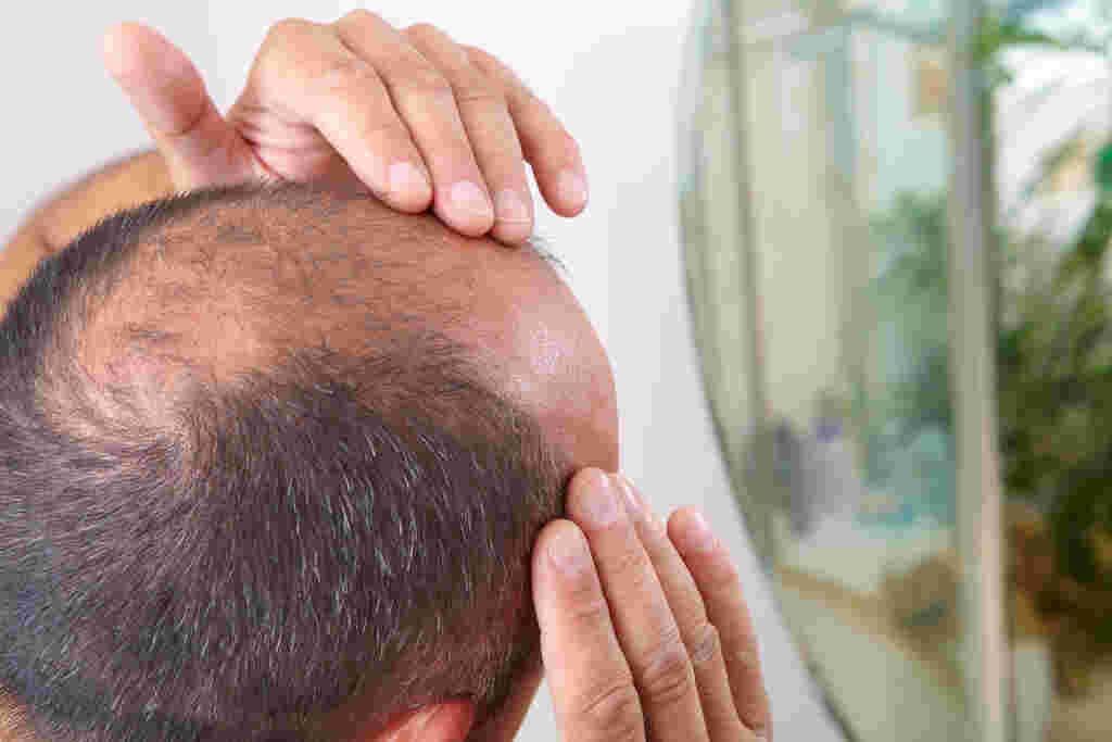 Calvície tem Cura? Conheça os tratamentos mais eficazes