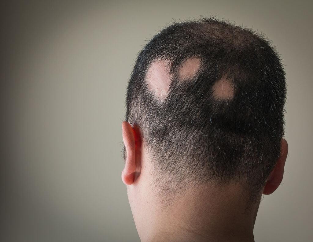 Alopecia areata: o que é, causas, sintomas e tratamento