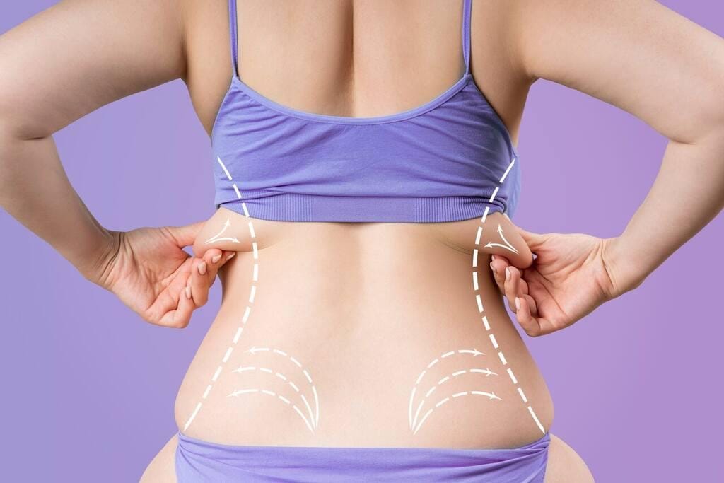 Lipo nas costas: como funciona a remoção das gordurinhas?