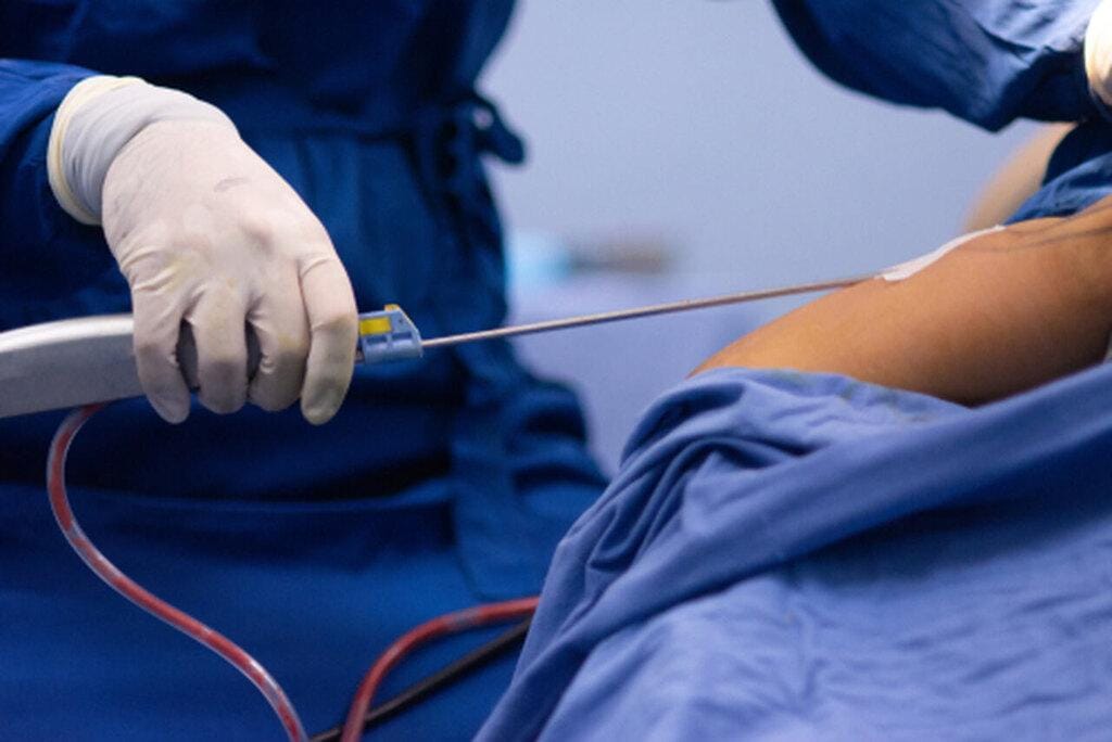 Cicatriz de lipo: como fica e principais cuidados para recuperação!