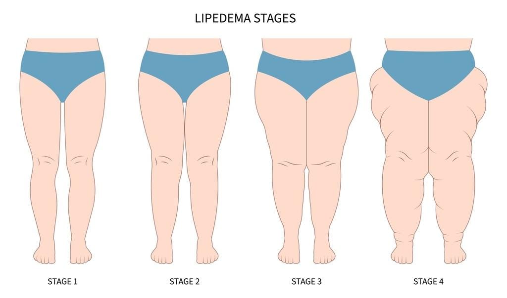 Estágios do lipedema: conheça o tratamento indicado para cada um deles