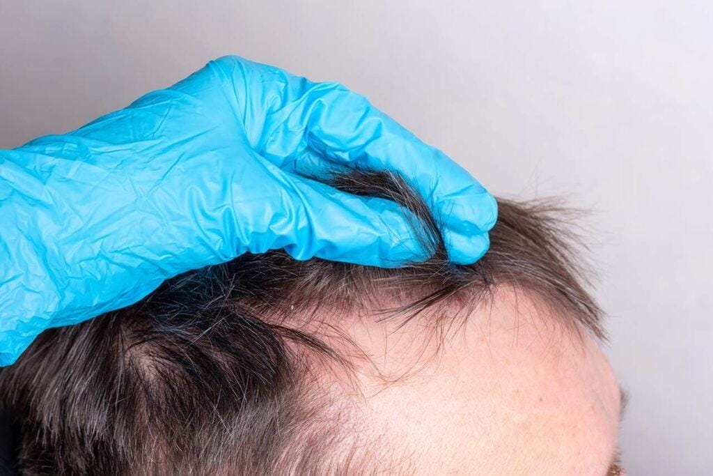 Afinal, transplante capilar sem raspar o cabelo é possível? Confira!
