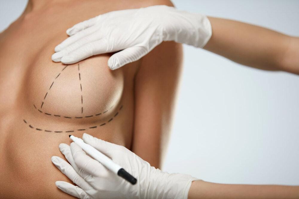 Cicatriz de mastopexia: confira quais são os tipos e como manter os cuidados no pós-operatório