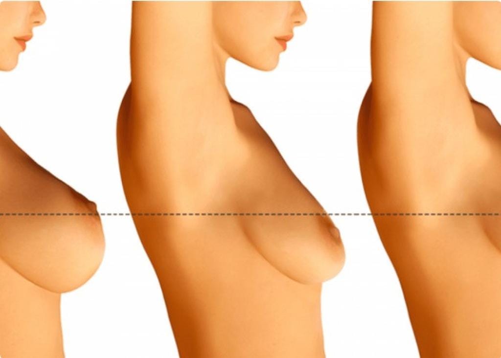 Seios caídos: entenda como é possível resolver essa queixa!