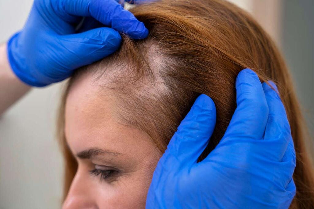 Alopecia por tração: causas, sintomas e como tratar a perda capilar