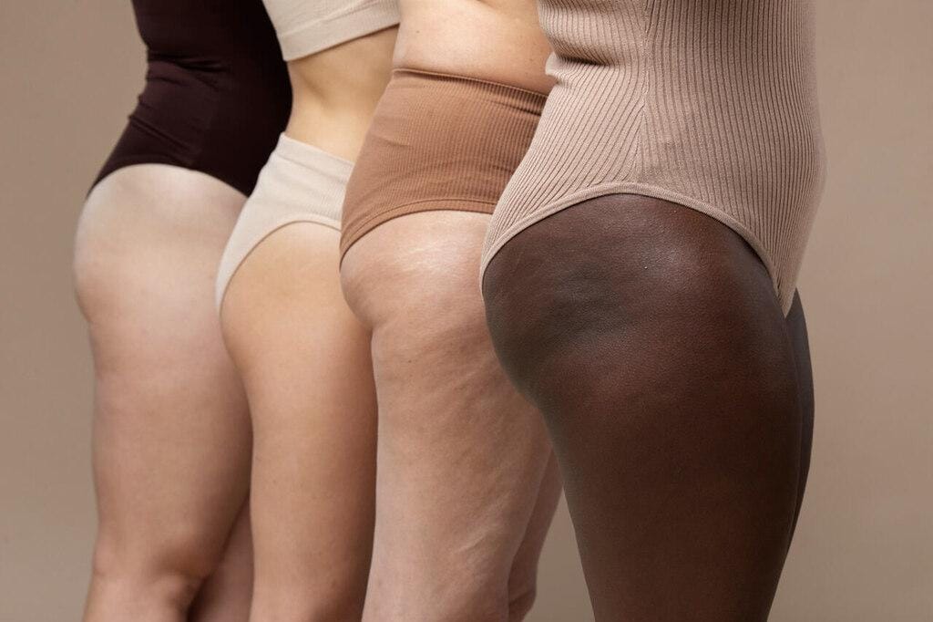Lipedema no quadril: o que é, como identificar e tratar