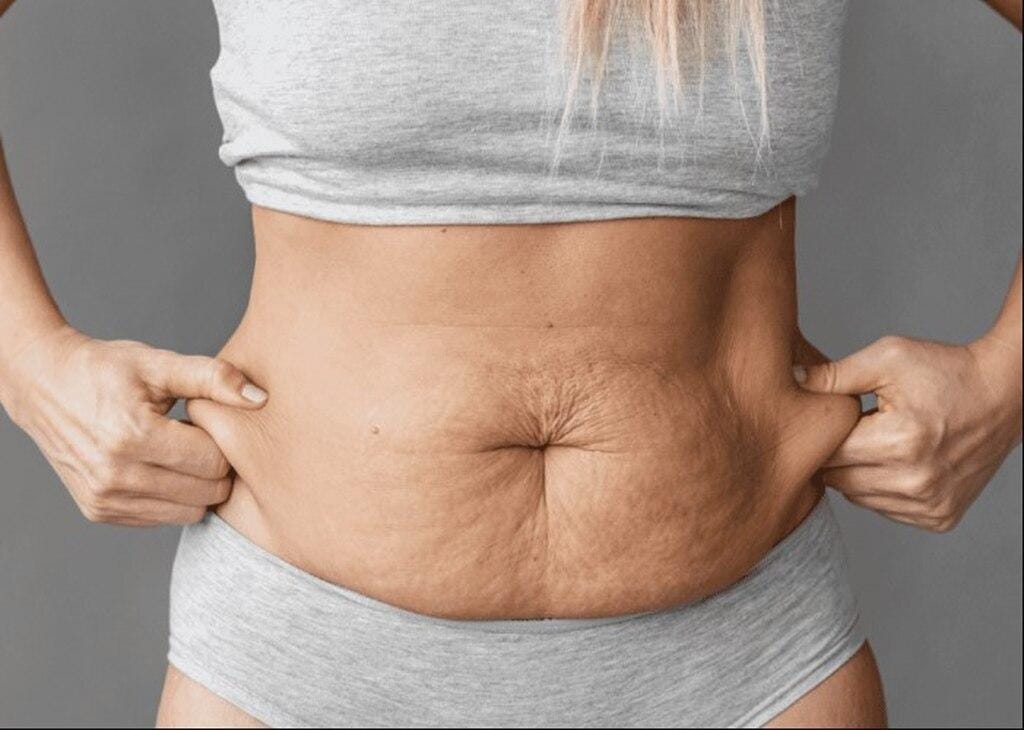 Flacidez na barriga: causas, cuidados e como tratar de forma eficaz