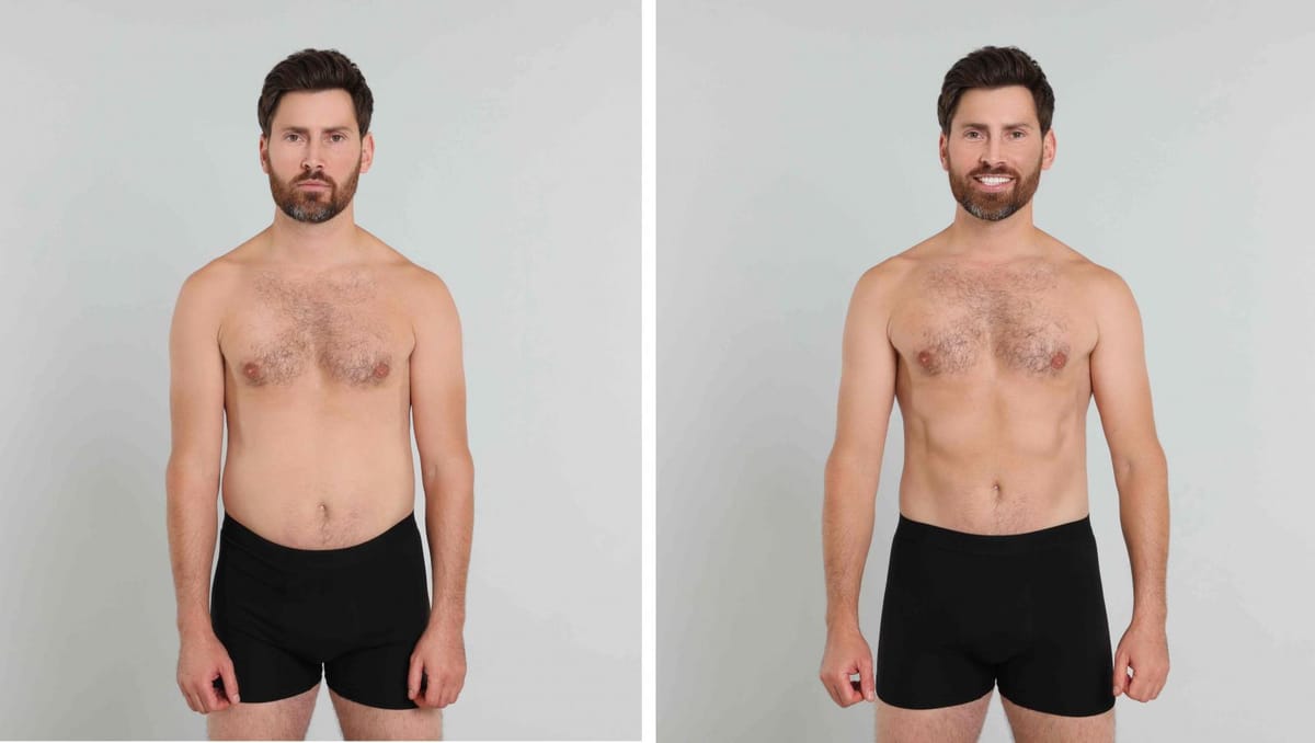 Abdominoplastia masculina: valores, indicações e resultados