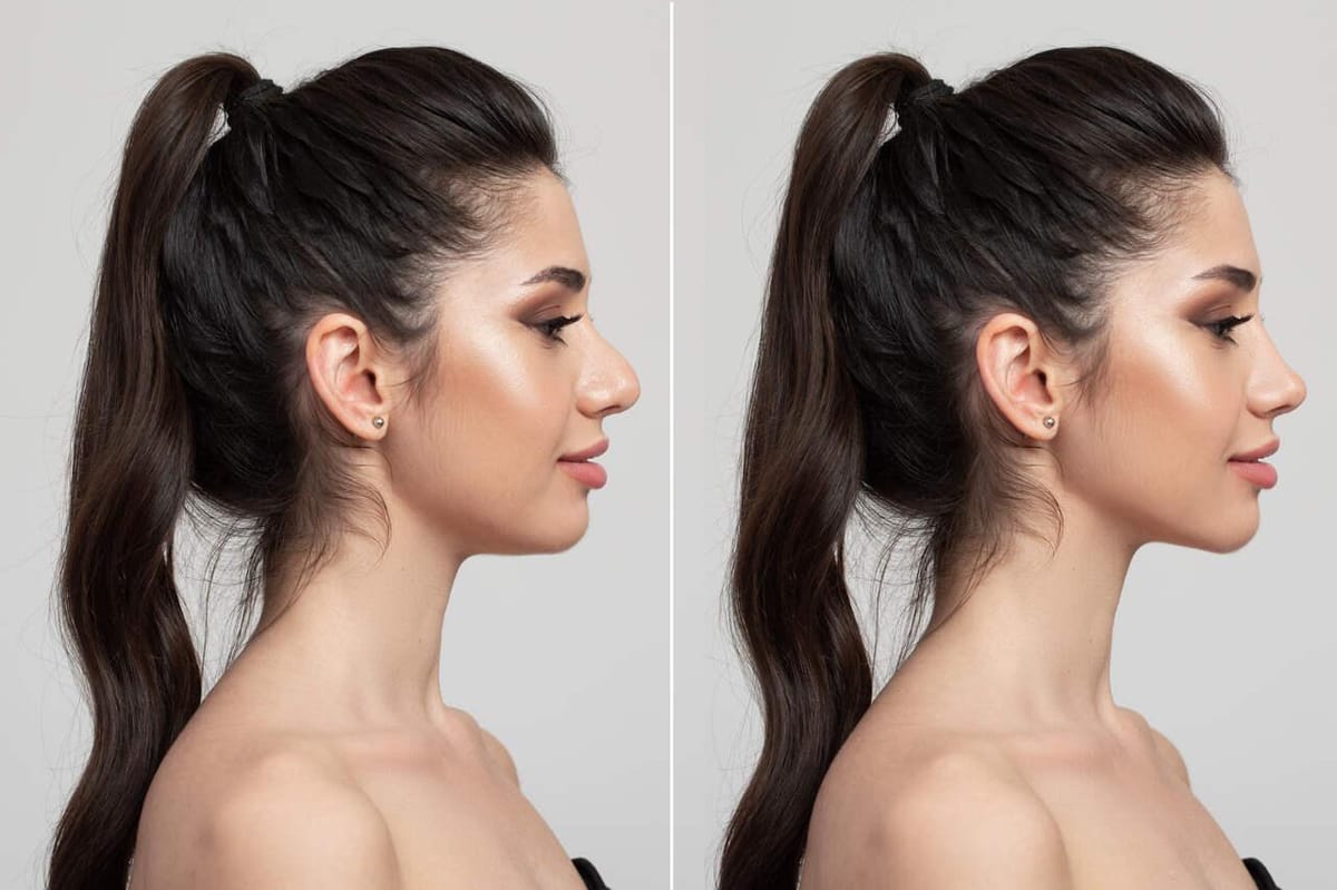 Perfiloplastia: o que é e como o procedimento harmoniza o rosto