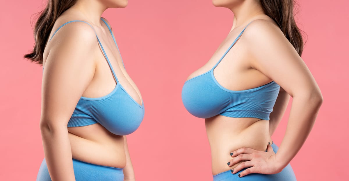 Quando a mamoplastia redutora é indicada?
