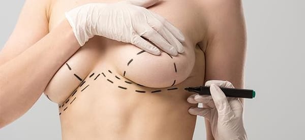 Como saber se você precisa de uma cirurgia de redução de mamas?