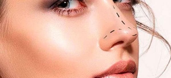 Entenda mais sobre como a rinoplastia pode melhorar sua saúde