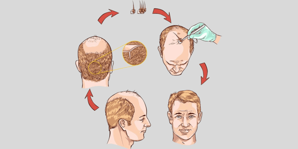 Qual o tempo de recuperação de um transplante capilar? 