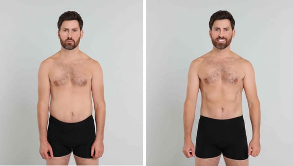 Abdominoplastia masculina: valores, indicações e resultados