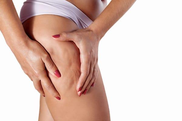 Celulite ou lipedema: diferenças, sintomas e como identificar corretamente