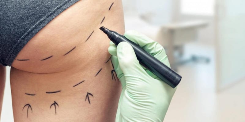 Aumento de glúteo: entenda o que é a Gluteoplastia