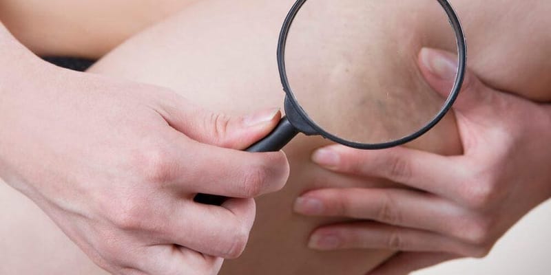 Carboxiterapia: saiba como funciona para tratar estrias e celulites