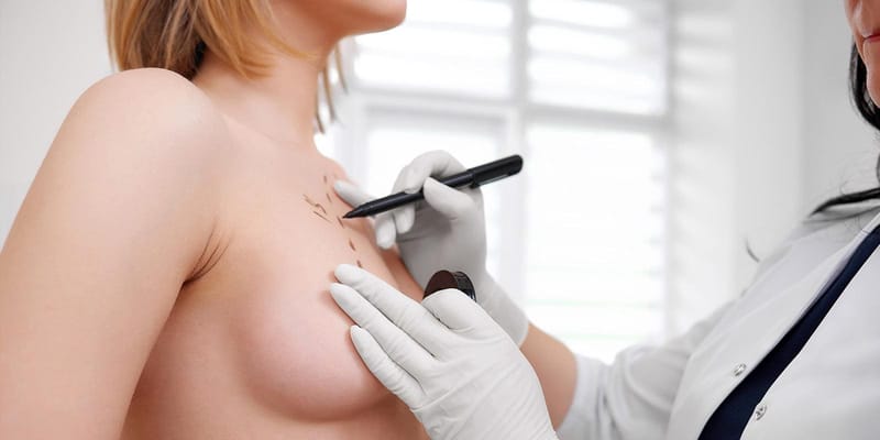 Mamoplastia em São Paulo