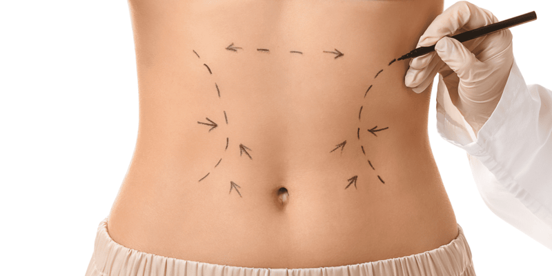 Qual o tempo de recuperação após uma Lipo HD?