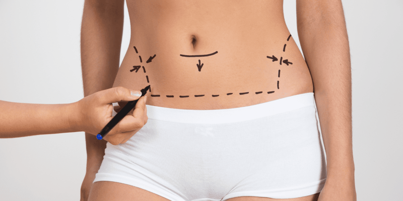 O que é possível fazer antes de optar pela lipoaspiração?