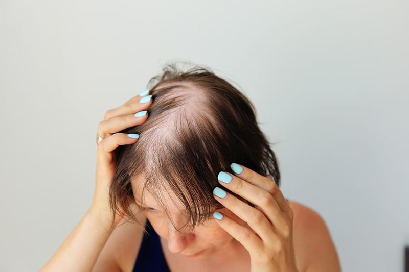 Calvície feminina: quais os sintomas? Saiba como tratar e resolver o problema