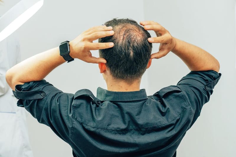 Tipos de Calvície: quais são, como identificar e tratar