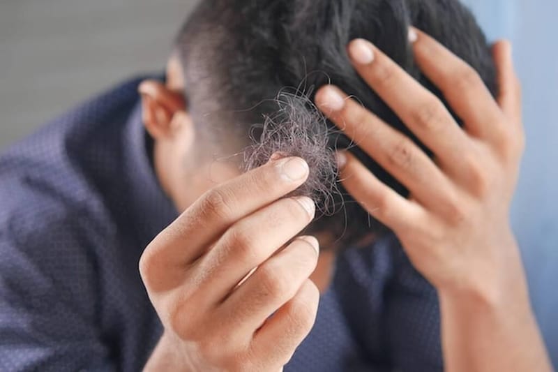 Calvície precoce: o que é, causas e como tratar
