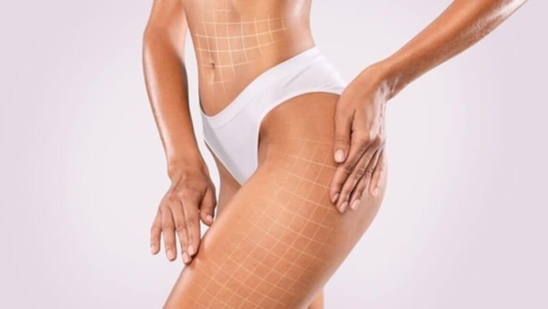 Lipo nas Coxas: como funciona e como é o pós-operatório