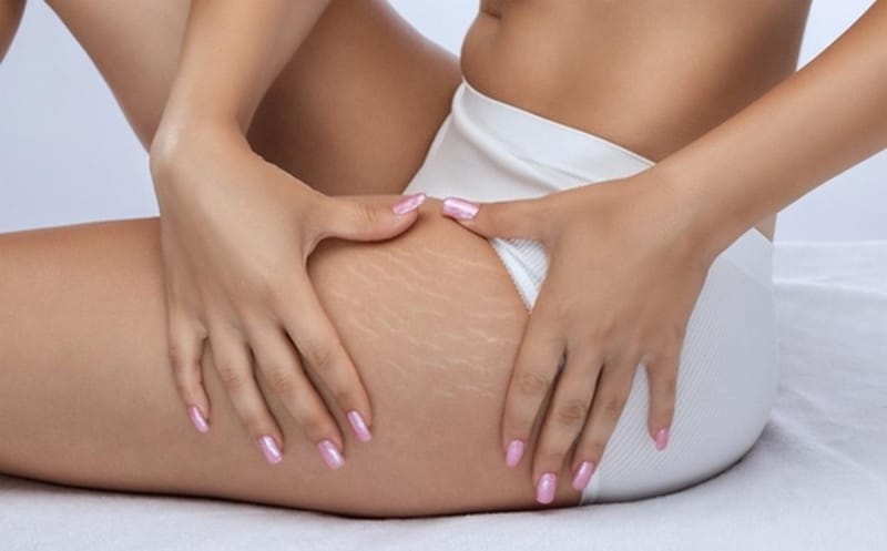 Cruroplastia: o que é e como funciona o lifting de coxas