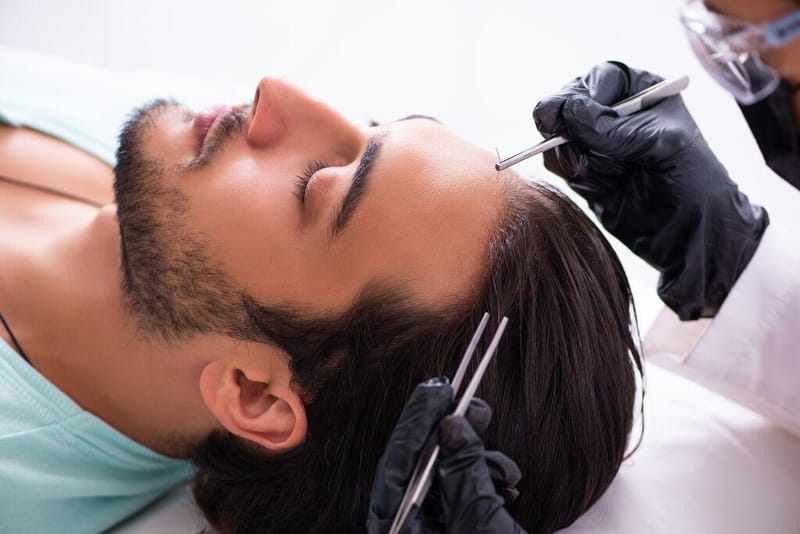 Tipos de Transplante Capilar: conheça as principais técnicas