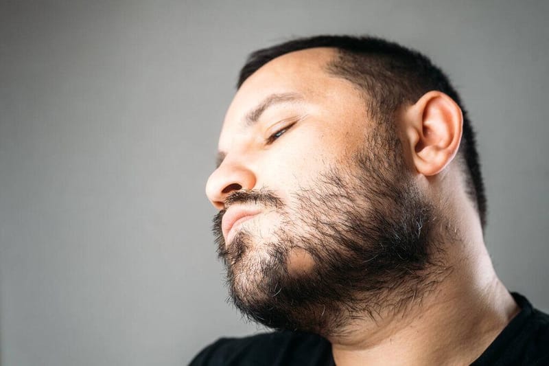 Quanto custa um transplante de barba em 2025? Confira