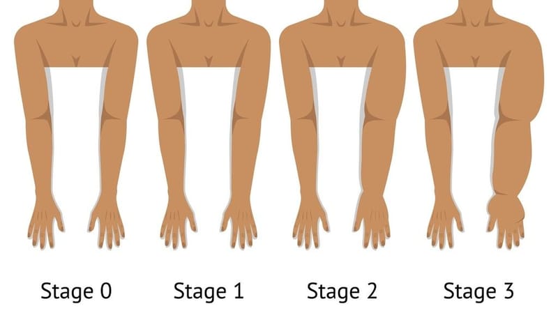 Lipedema nos braços: causas, sintomas e tratamentos