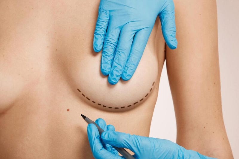 Saiba quanto custa uma mastopexia e entenda o que influencia no valor da cirurgia