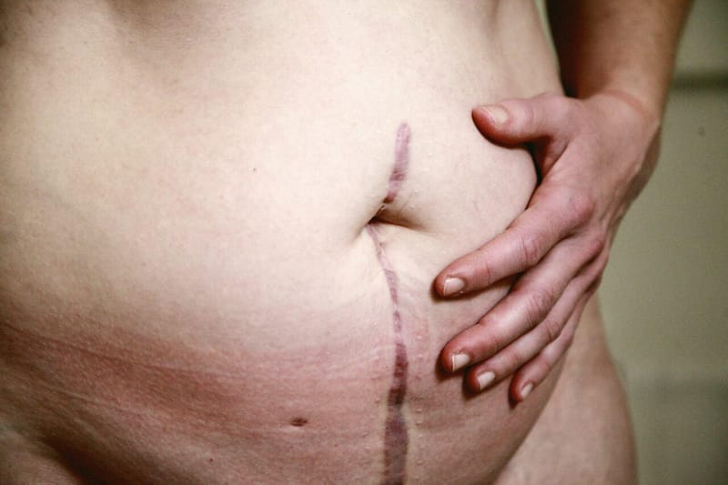 Barriga em avental: causas e tratamentos para o abdômen