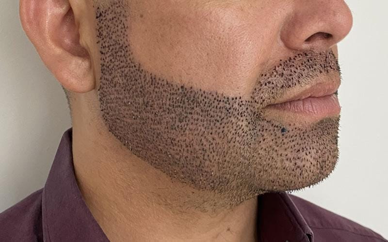 Transplante de barba na Clínica SER Cirurgia Plástica