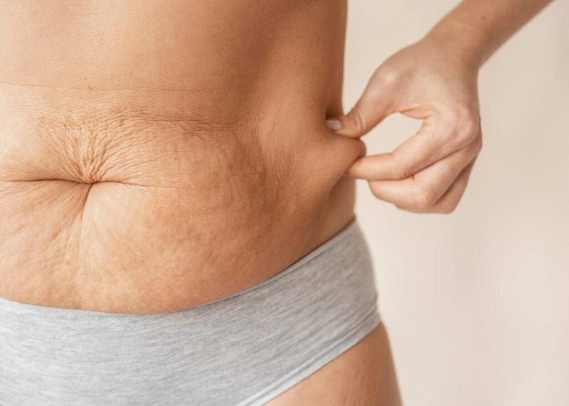 Excesso de pele: causas, prevenção e tratamentos eficazes