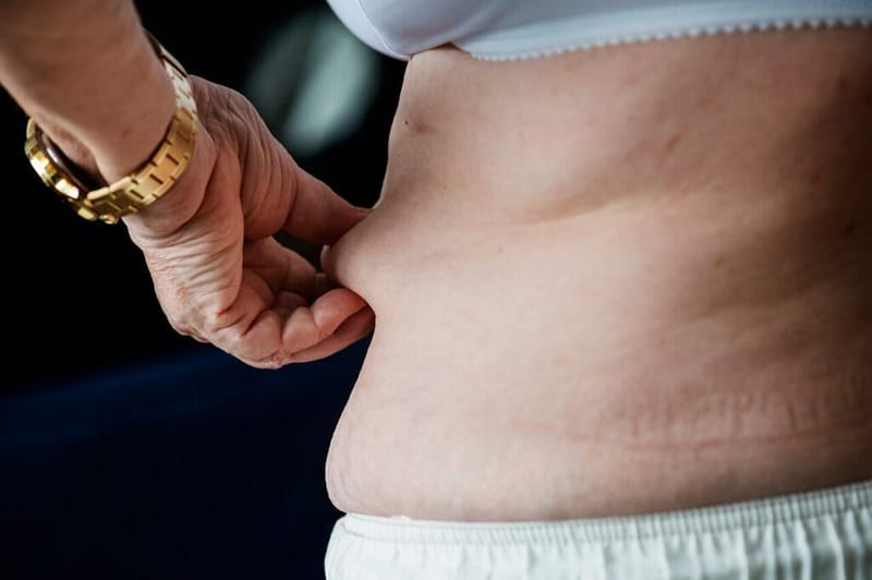 Body lifting: remodelando o corpo com segurança e resultados naturais