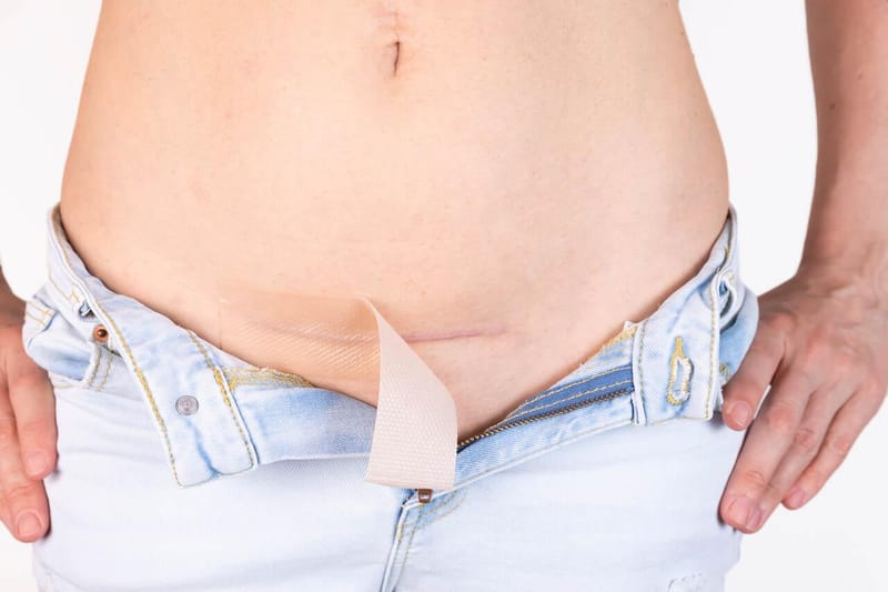 Quelóide após cirurgia: o que causa e quais os melhores tratamentos