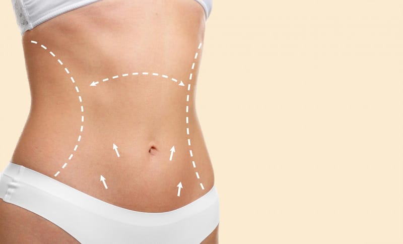 Cuidados essenciais após abdominoplastia